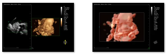 Comparison of grayscale and color 3D fetal ultrasound imaging displayed on a medical monitor.