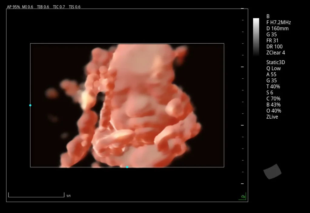 A 3D ultrasound scan depicting a fetus in the womb with detailed imaging parameters displayed on the screen.